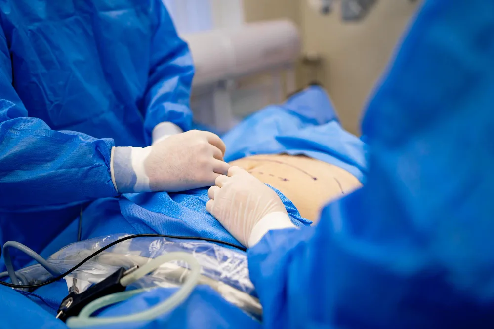 Hernia abdominal en Puebla