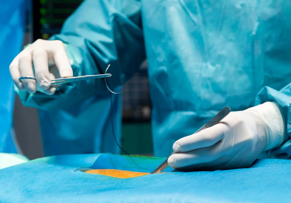 Hernia inguinal en Puebla