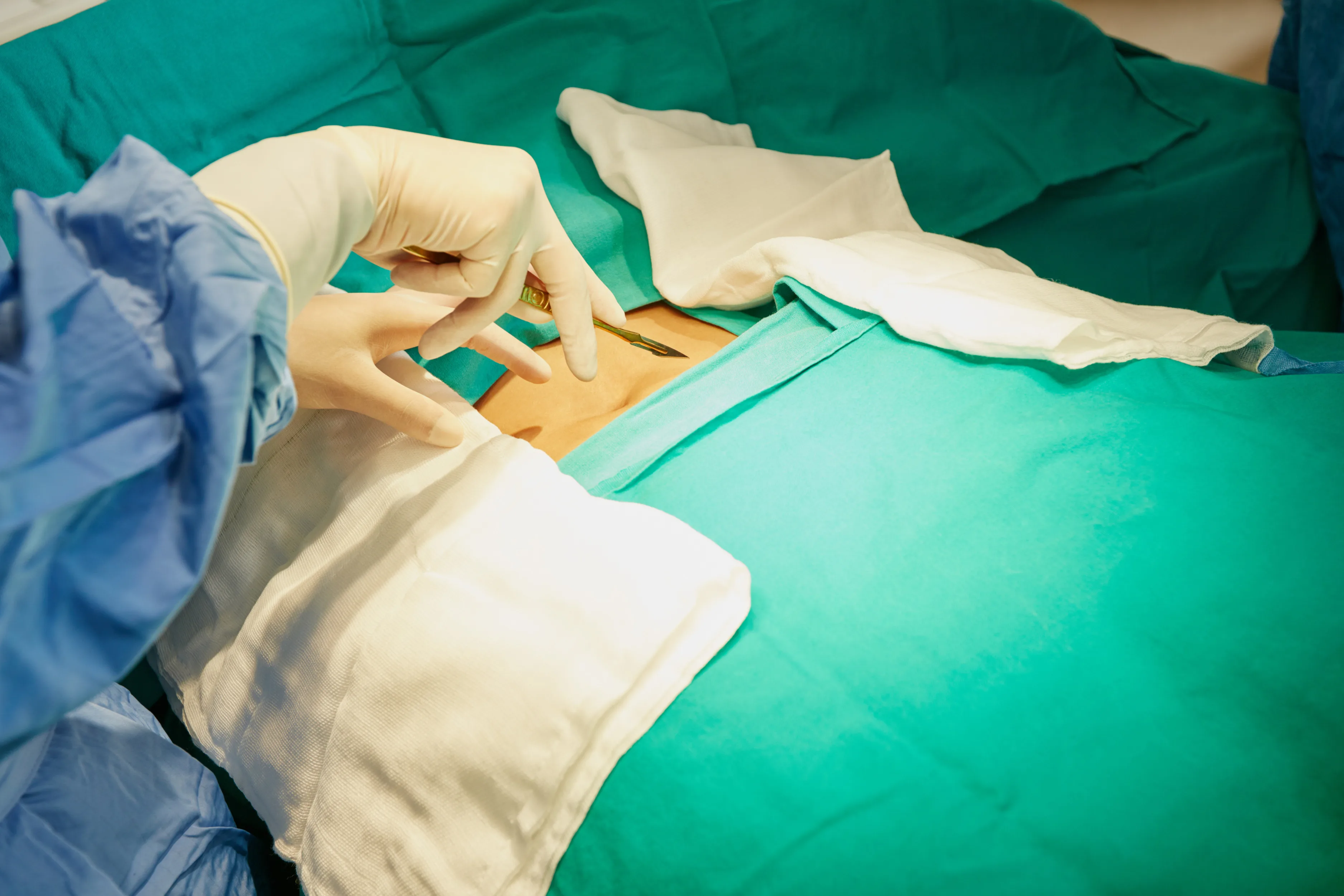 Hernia umbilical en Puebla